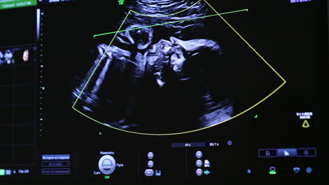 fetal ultrasound images