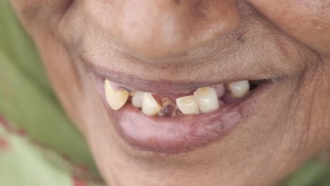 dental issues in older adult