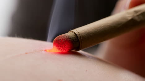 close-up of moxibustion therapy with a glowing moxa stick on skin