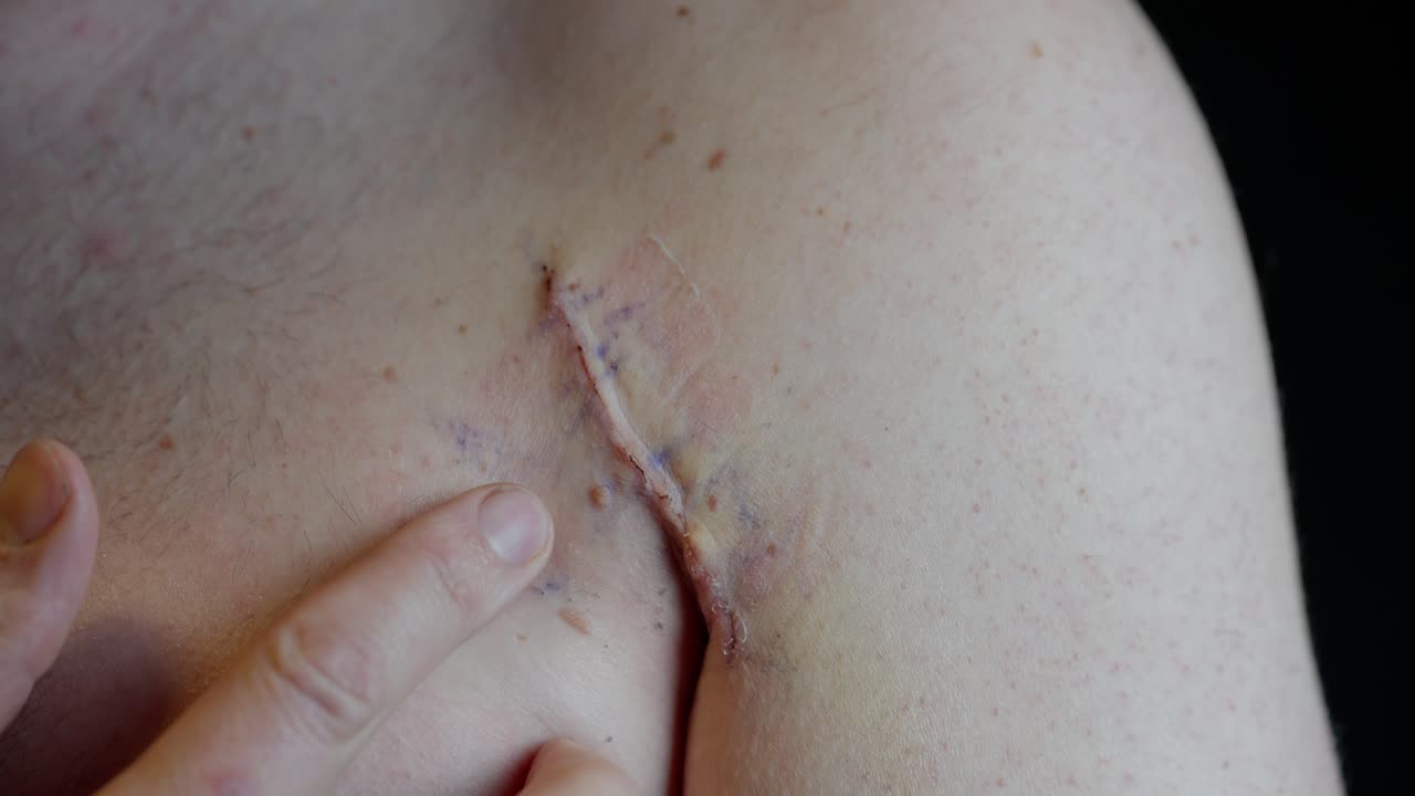 Fresh pectoralis surgery scar with red edges. Fingers gently touch healing skin near shoulder and arm