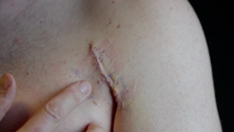 fresh pectoralis surgery scar with red edges. fingers gently touch healing skin near shoulder and arm