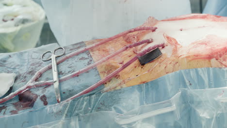 chest tubes with blood in body. specialized medical equipment to drain blood and remove air from cavity after surgery procedure in operating room