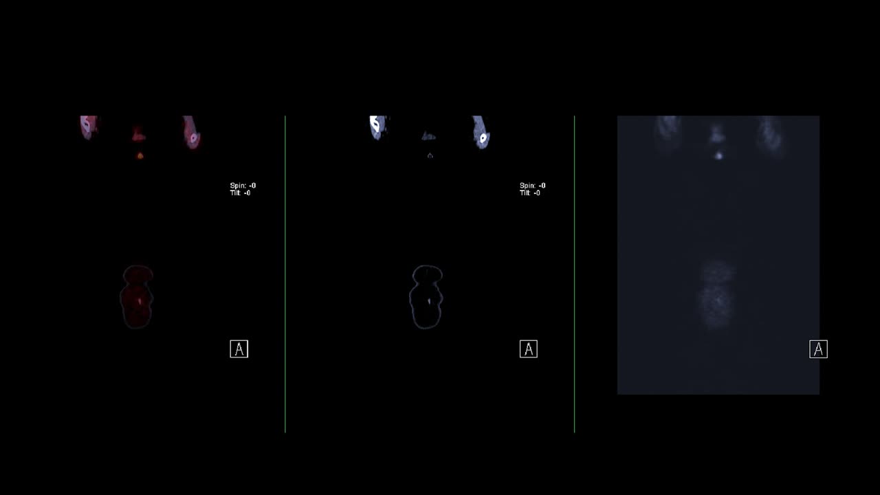 Collection PET CT ( Positron Emission Tomography )  of whole human body 3d rendering image red color tone compare coronal view.