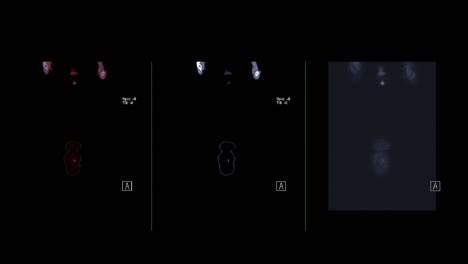 collection pet ct ( positron emission tomography )  of whole human body 3d rendering image red color tone compare coronal view.
