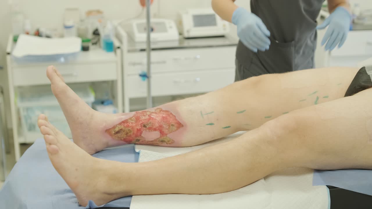 herida de úlcera en la pierna en el tratamiento de venas varicosas en el procedimiento de flebología. unión de venas con pegamento biológico