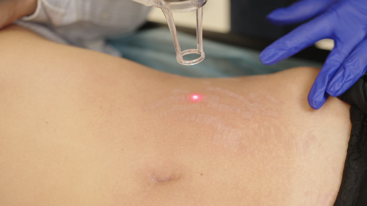 복부에 대한 레이저 치료