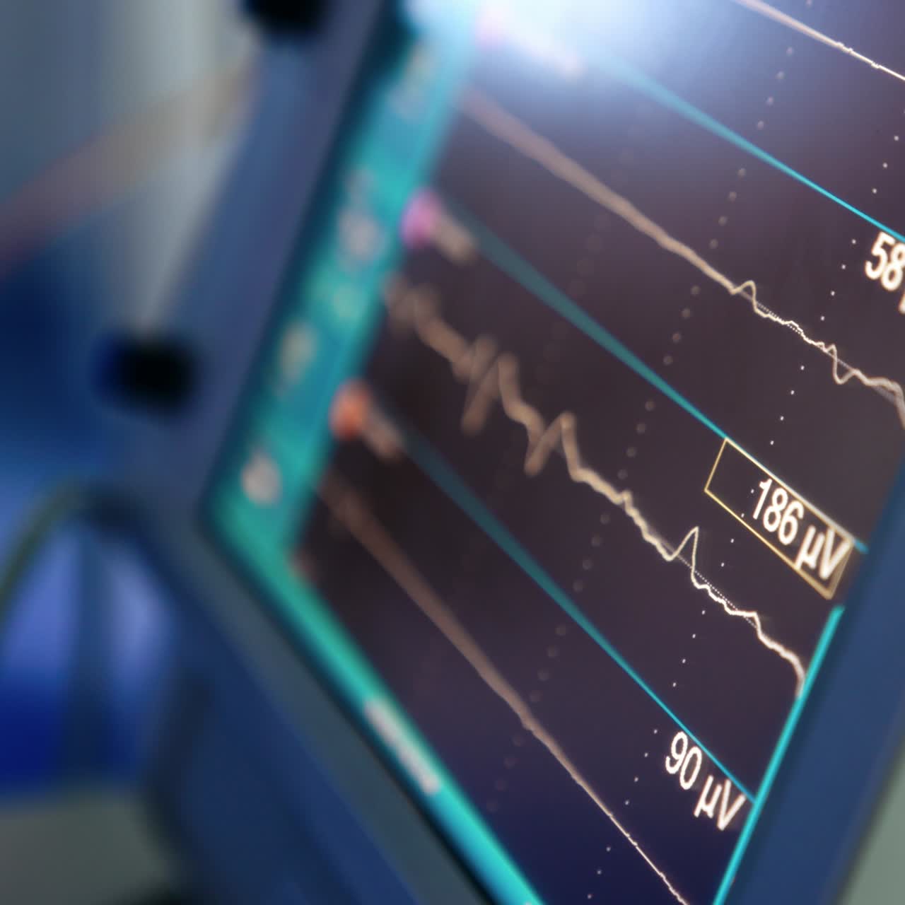 Schermo acceso di monitor dei nervi in sala operatoria. Primo piano. Sfondo sfocato.
