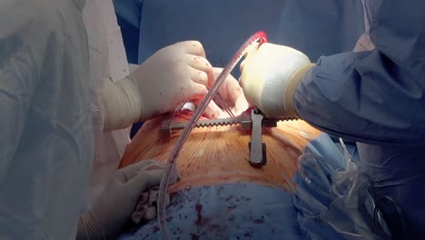 drainage of blood flow during the operation 3 close-up