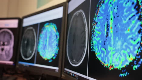brain scans on multiple computer screens