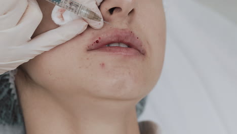 lip augmentation with dermal filler injection