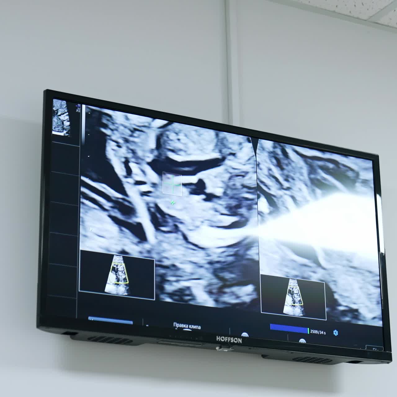 Black and white screen with the image of ultrasound scan. Pregnancy check up at clinics