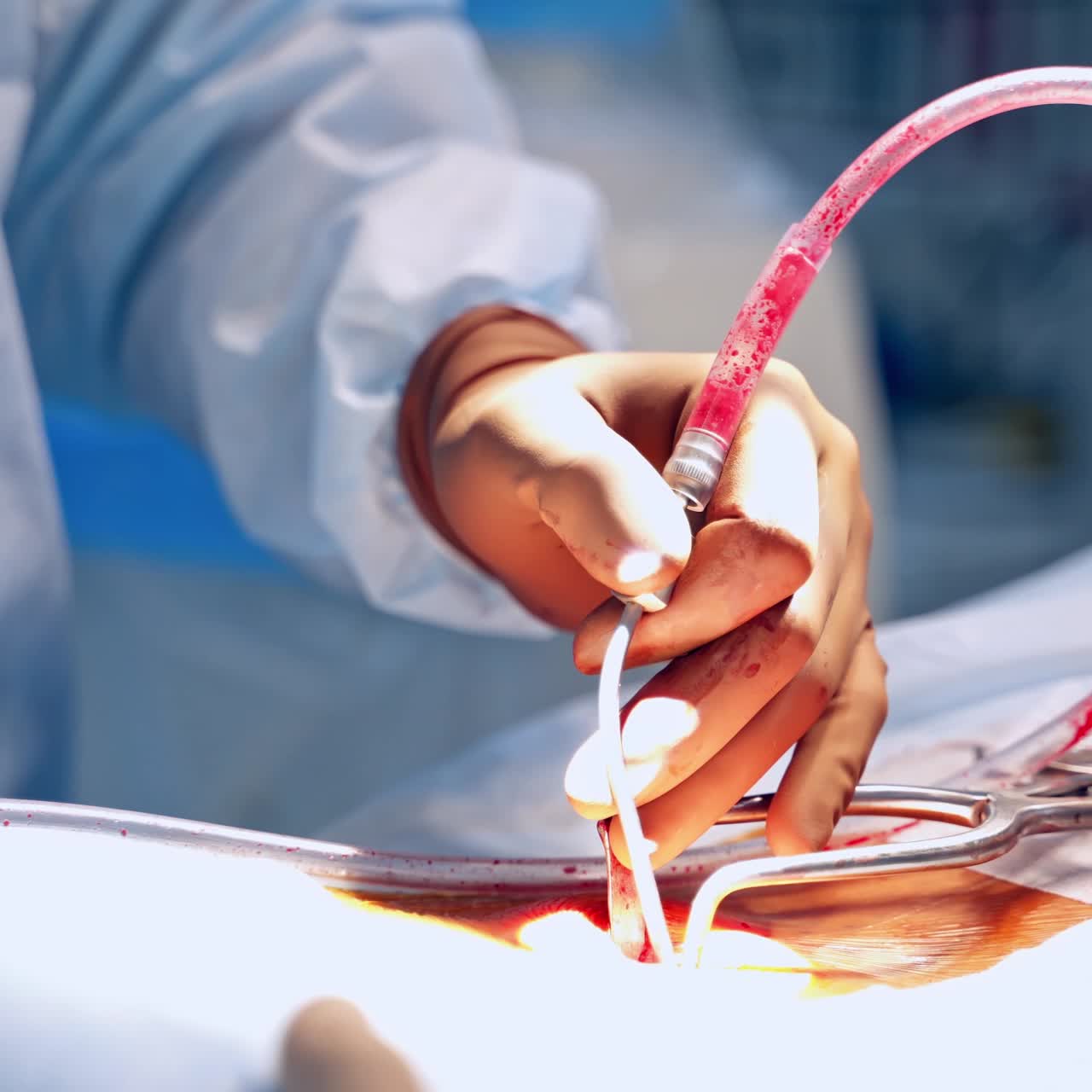 Doctor uses medical tools during surgery. Specialist performing an operation. Medical instruments and tube with blood in surgeon's hands. Close-up.
