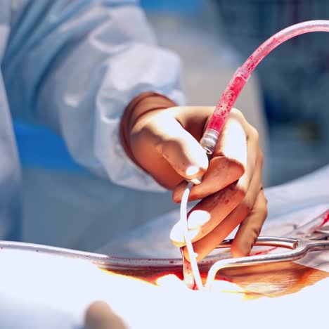 doctor uses medical tools during surgery. specialist performing an operation. medical instruments and tube with blood in surgeon's hands. close-up.