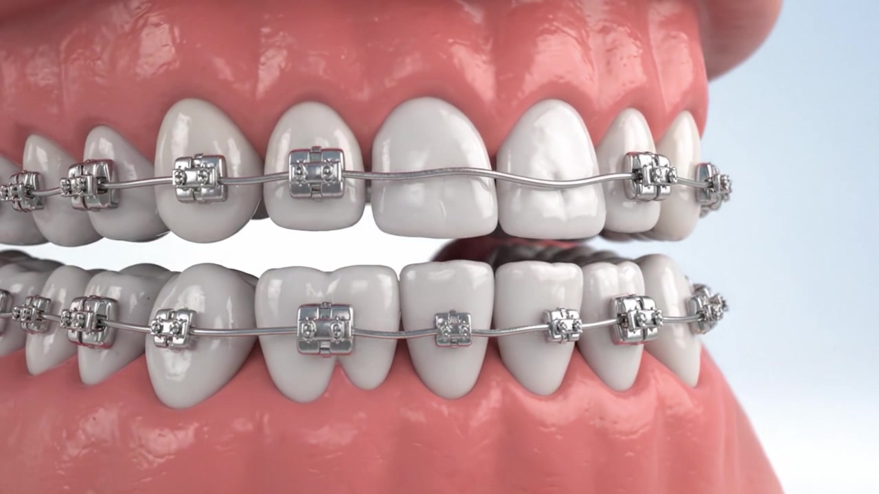 A Detailed Examination of Orthodontic Braces on Teeth, Showcasing the Upper and Lower Jaw Alignment with Clear Visibility of Dental Structure and Bracket Mechanics