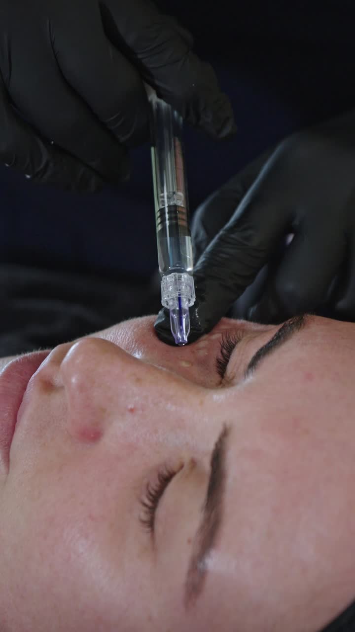 Un medico estetico qualificato, che indossa un camice nero e guanti neri sterili, esegue un'iniezione perioculare precisa con una siringa sottile su una paziente rilassata che giace comodamente su