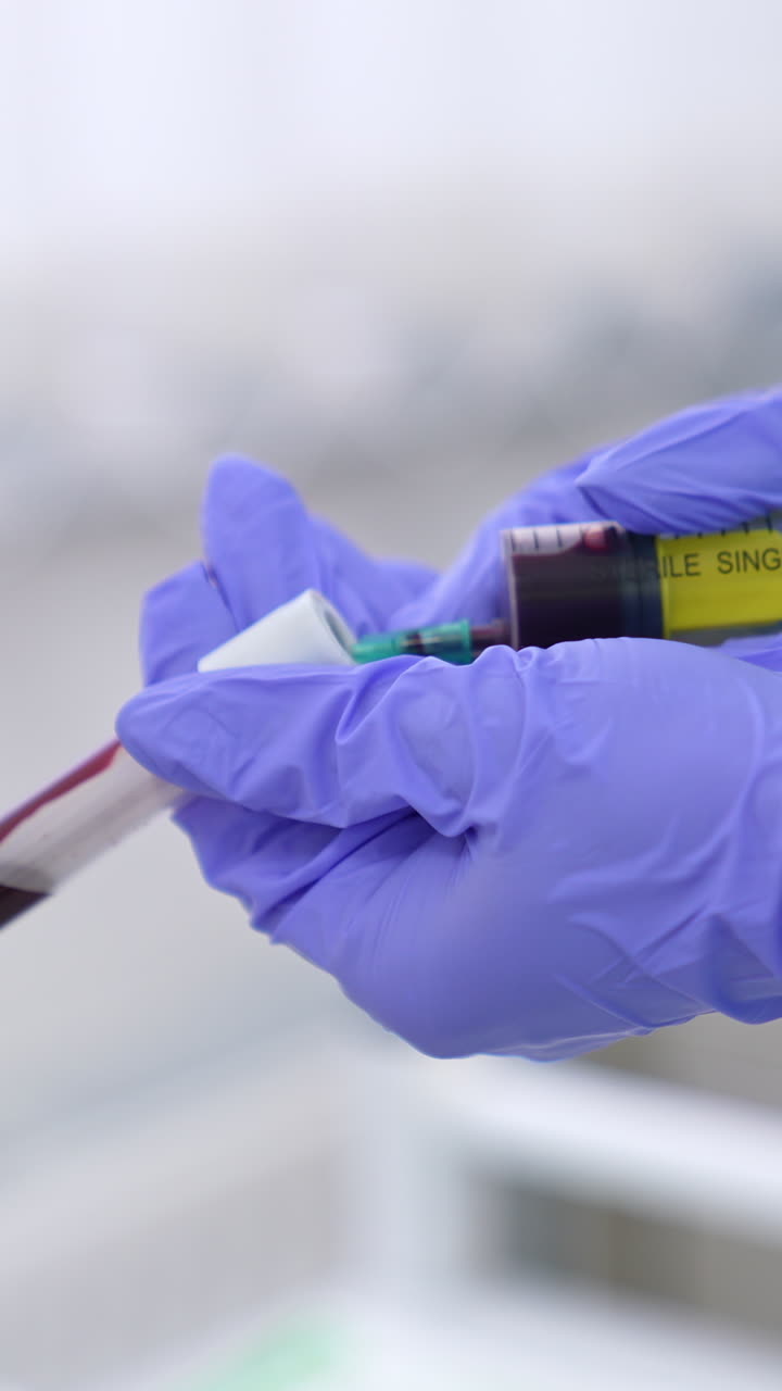 Filling the test tube with vein blood from syringe. Gloved hands preparing sample of blood for analysis. Close up. Vertical video