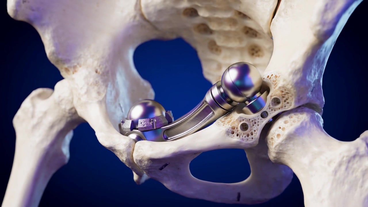 Medical Animation Of Human Hip Joint Replacement Surgery In Detailed Medical View