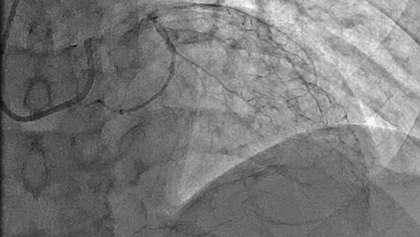 closeup x-ray of a beating heart, coronary angiogram diagnostic test at a medical hospital