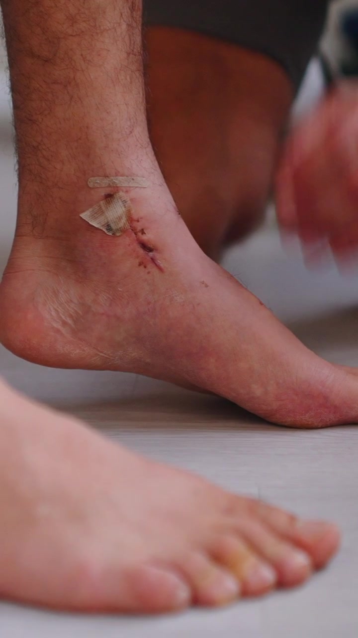 Fisioterapista che esamina la cicatrice post-operatoria alla caviglia del paziente.