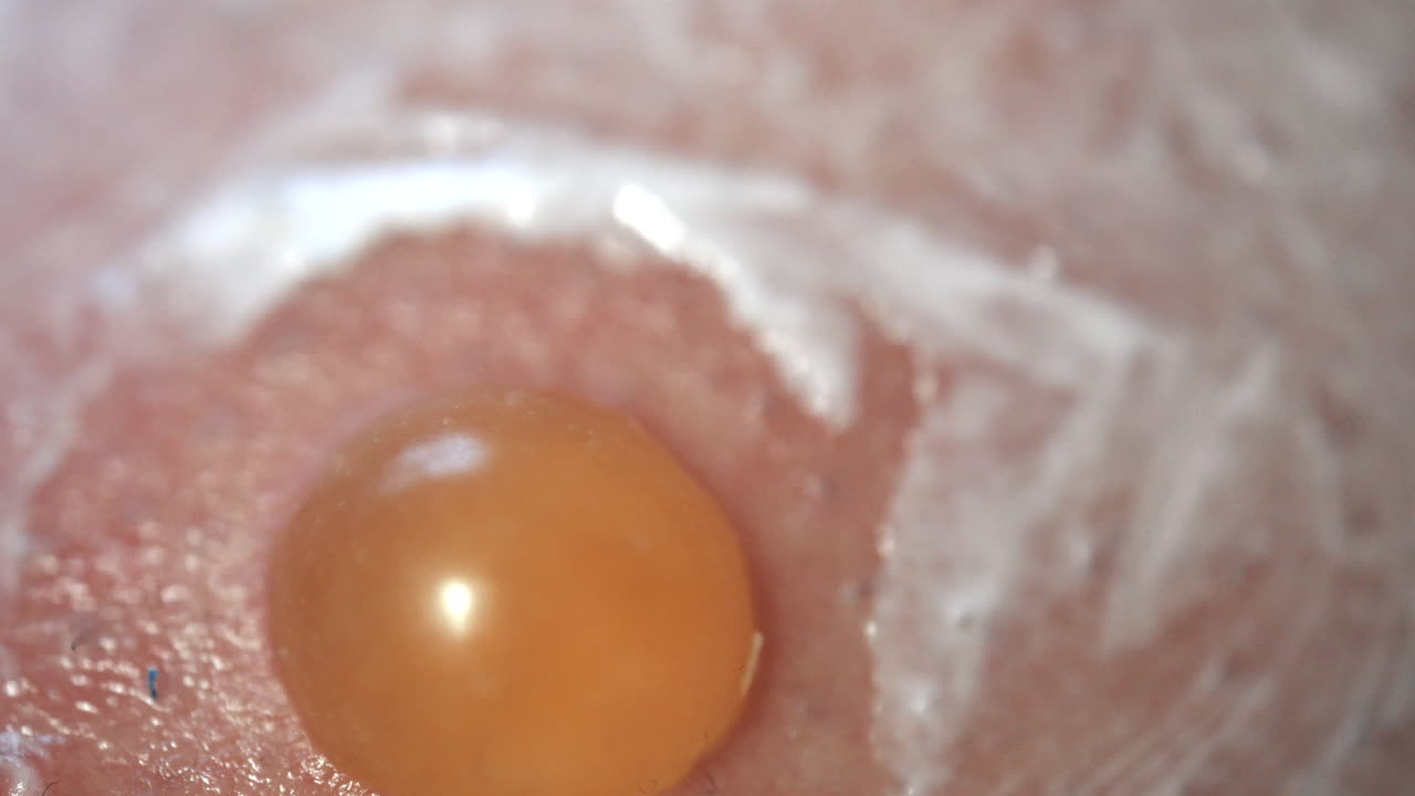 Closeup Of Infected Blister With Fluid, Ointment Applied For Treatment Of Pain And Infection