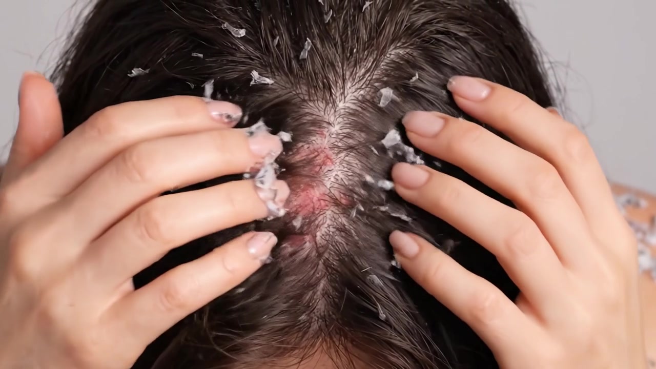 Understanding Scalp Health: A Close-Up Examination of Flaking Skin and Irritation on the Head with Visible Dryness and Redness