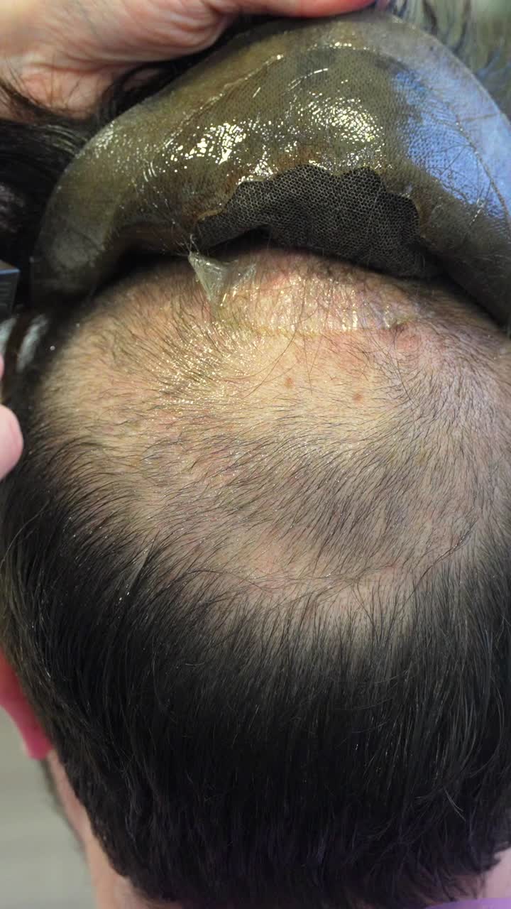 Hair Replacement System Installation