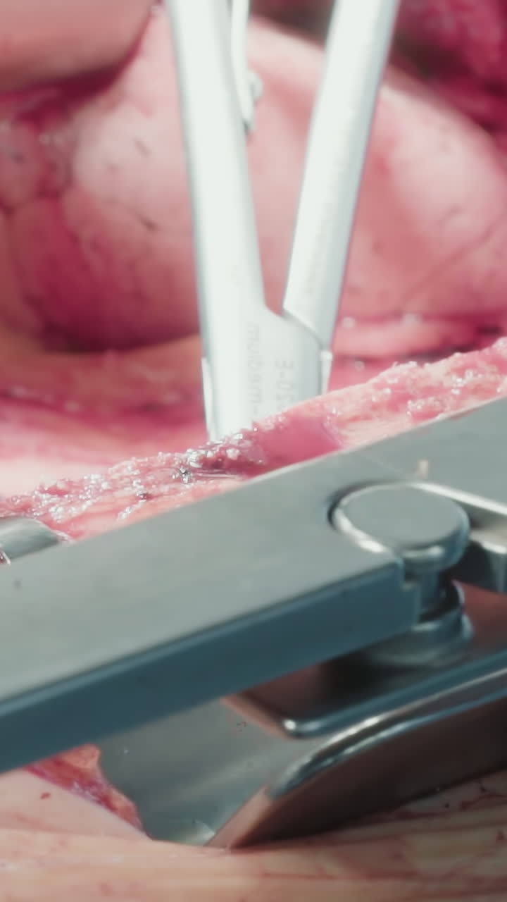 el cirujano utiliza herramientas durante la operación cardíaca. el médico asegura una atención meticulosa a los detalles y la seguridad del paciente durante la cirugía de bypass de la arteria coronaria