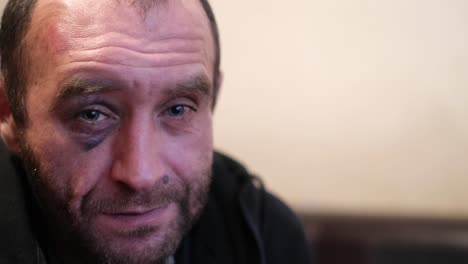 man with a black eye