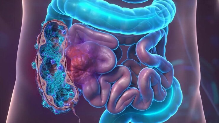 3D animation of a digestive system with a highlighted diseased section of the intestine