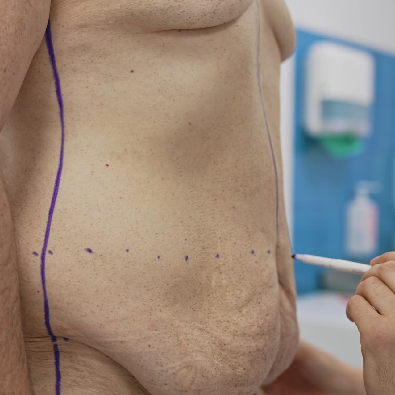 Surgeon marks the abdomen with a marker for liposuction. plastic doctor marking problem zones on a man's body. Result of losing weight