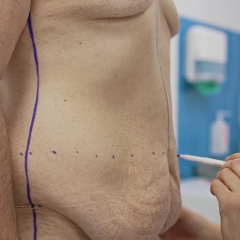 Surgeon marks the abdomen with a marker for liposuction. plastic doctor marking problem zones on a man&#039;s body. Result of losing weight