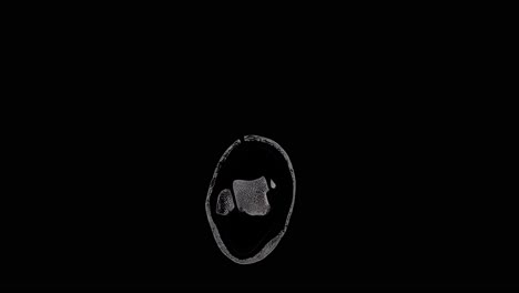 mri scan of a foot showing multiple small fractures, slowly scanning from top to bottom