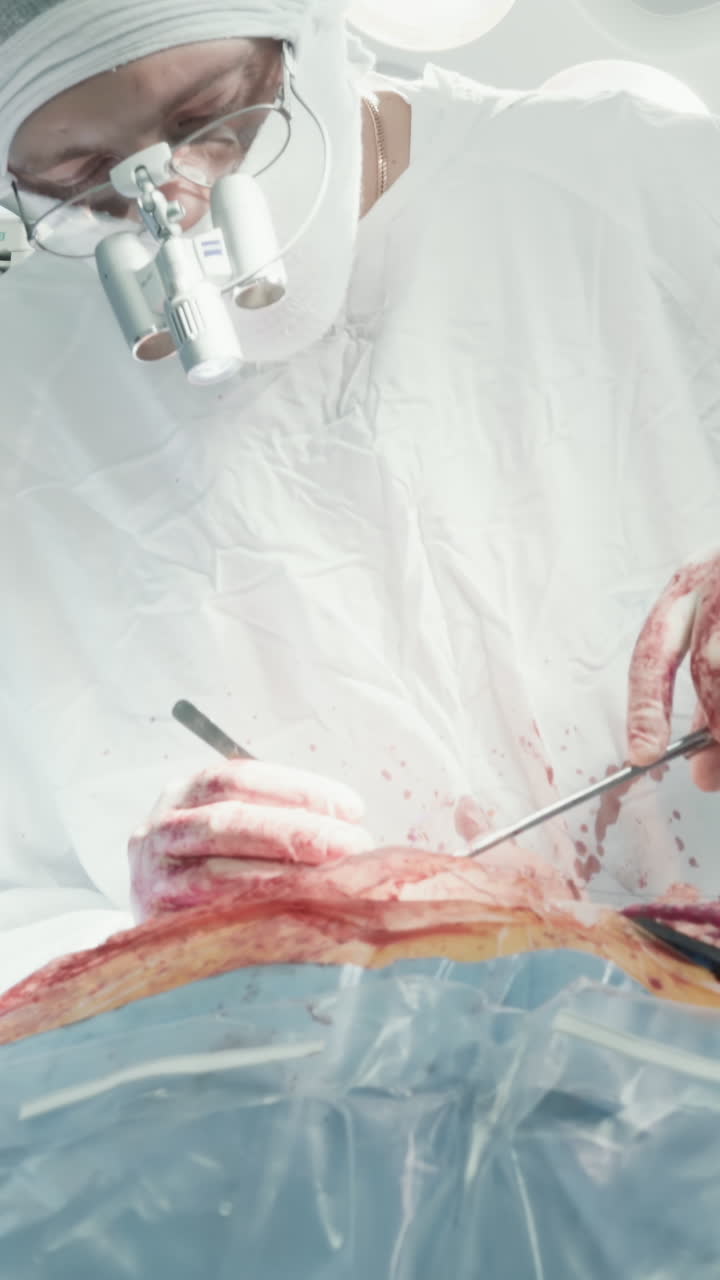 cirujano con binoculares opera a un paciente. hombre médico en uniforme utiliza instrumentos médicos durante la cirugía de derivación de la arteria coronaria en la sala de operaciones