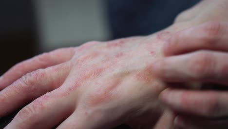 reacción alérgica al rascado de la mano de una mujer con manchas rojas de psoriasis