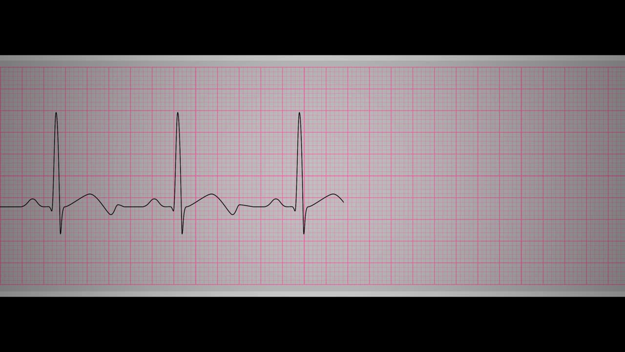 ecg (사이너스 브래디카디아)