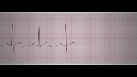 ekg sinus bradycardia