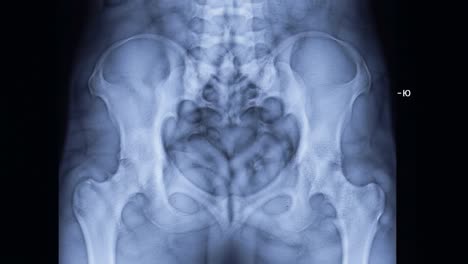 this radiographic display presents a detailed view of the human pelvic anatomy, showcasing the bone structure. the clarity in the outline highlights the features necessary for medical analysis.
