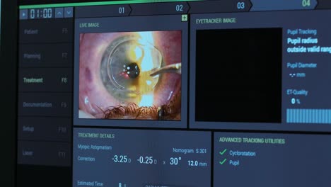 ophthalmic surgery. view on the screen of medical monitor in operating room. lasik