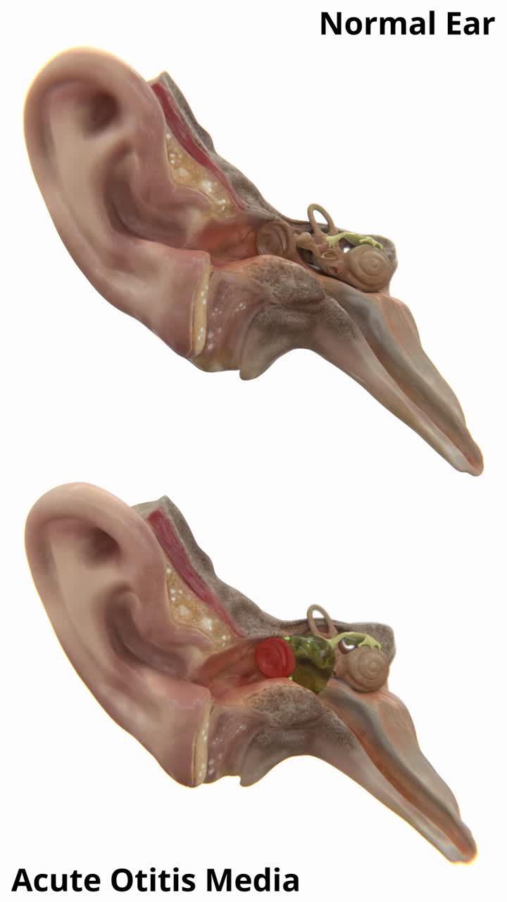 Video of Normal ear vs Acute otitis media | Normal ear vs Acute otitis medias video in vertical | Ear Infection video in vertical