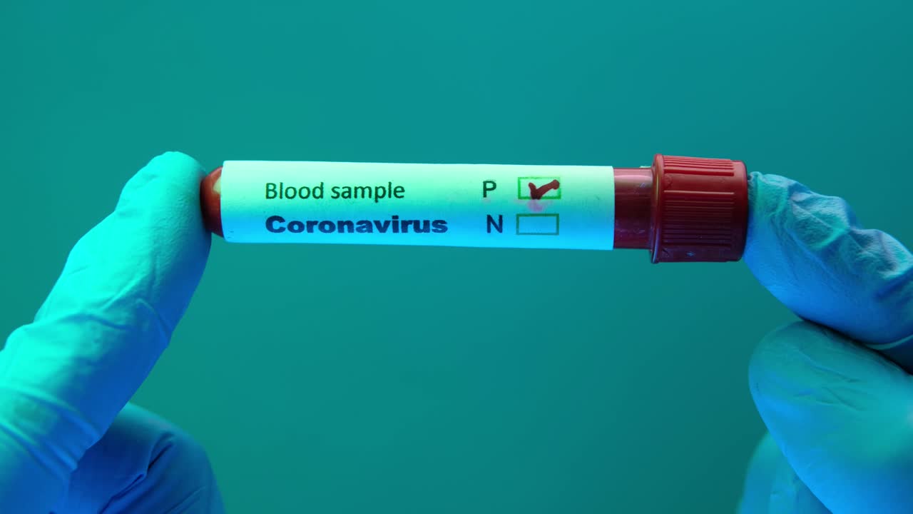 prueba de muestra de sangre de coronavirus