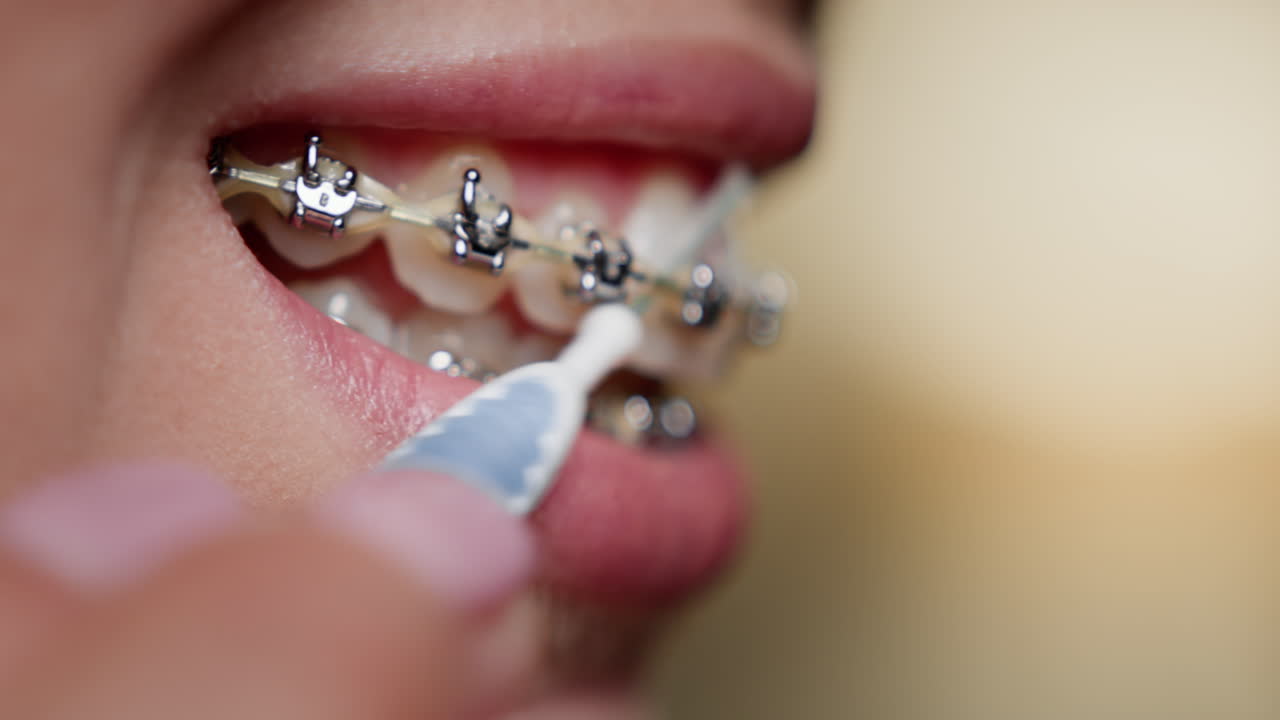 Braces Cleaning with Interdental Brush