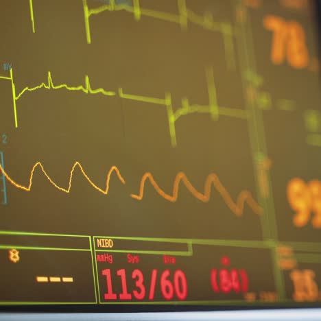 ecg monitor in operating room. colorful waves on the screen of a monitor during surgical operation in the hospital. close-up.