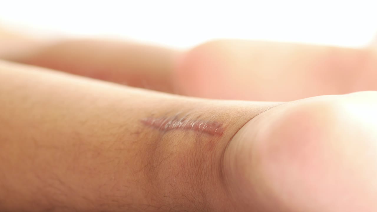 Close up image of a scar on a person's ankle