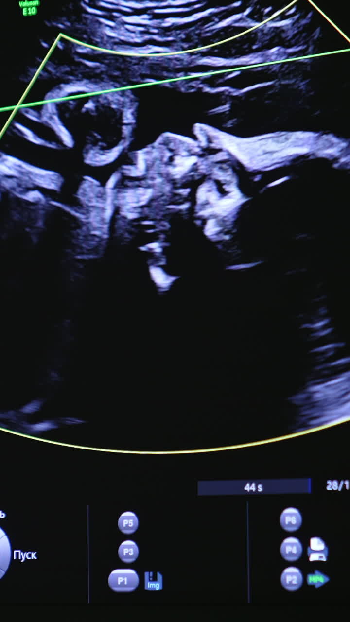 Watching the unborn baby move in mom's abdomen. Child image on the screen of ultrasound machine. Vertical video