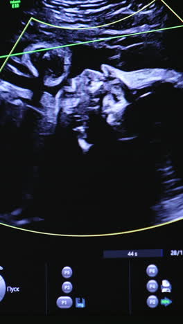 watching the unborn baby move in mom's abdomen. child image on the screen of ultrasound machine. vertical video