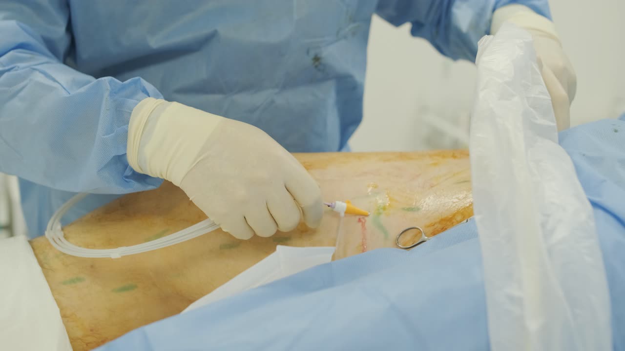 aplicación de bioglue en el tratamiento quirúrgico de la úlcera de la pierna