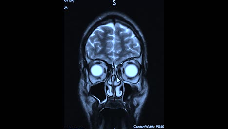 mri result scan of a human brain magneto resonance therapy on the computer screen