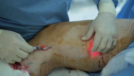 leg ulcer wound in treatment for varicose veins in phlebology procedure. bonding of veins using bioglue