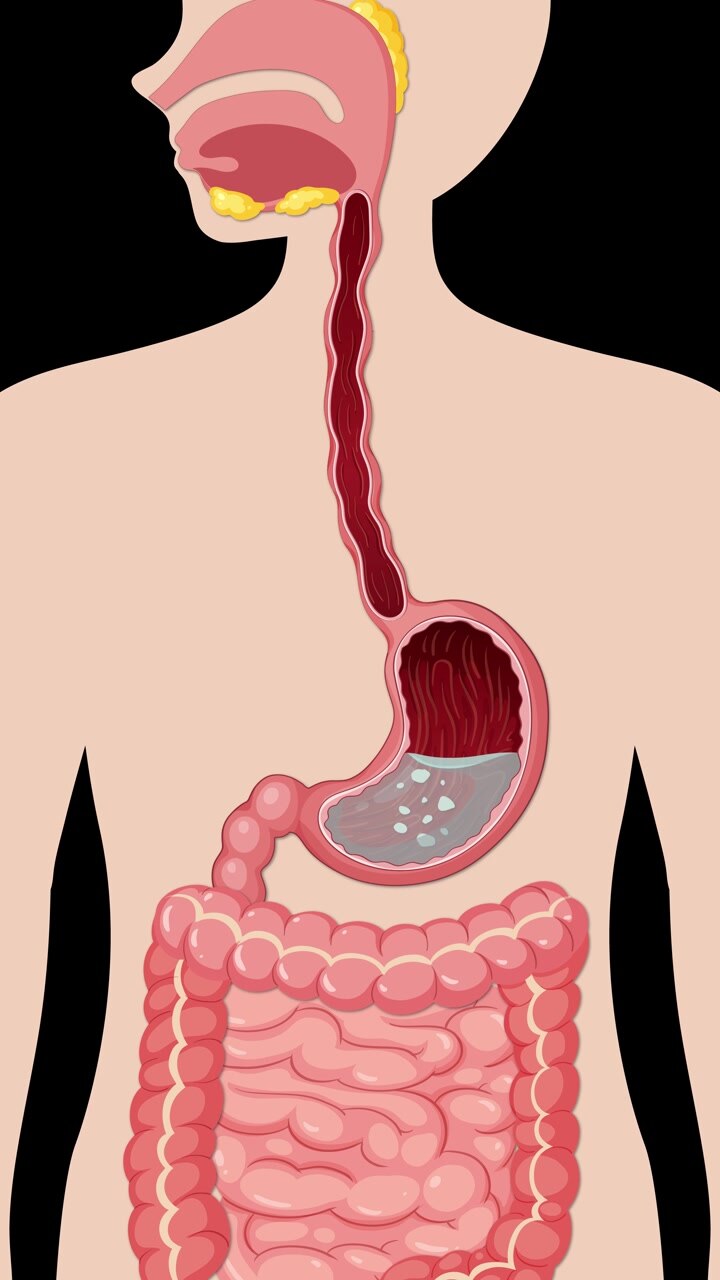 Anatomical diagram illustrating gas bubbles forming in the stomach and intestines on black background.