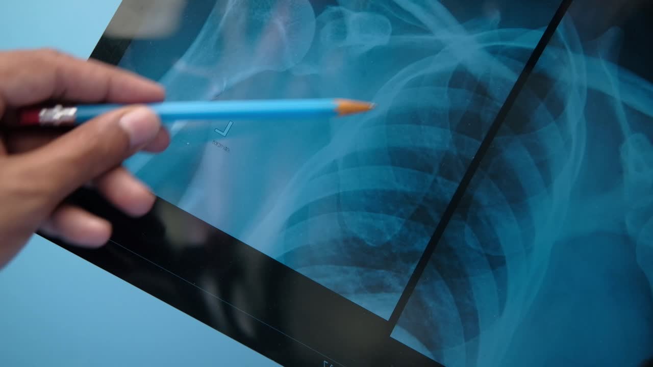 X-ray of Shoulder and Ribs